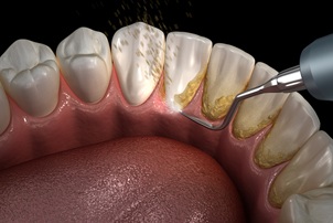 Up-close photo of a teeth cleaning