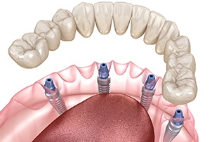 Diagram of an implant denture in Centerville