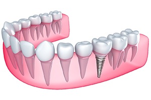 Digital image of a single unit dental implant in Centerville.