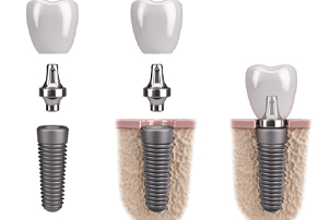 parts of dental implant