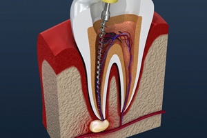 Root canal therapy