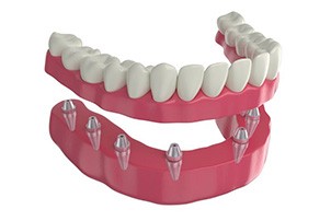 Illustration of implant denture for lower arch
