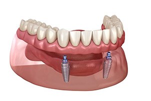 Illustration of removable, ball-retained implant denture