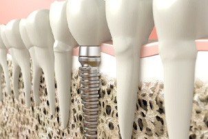 Digital illustration of a dental implant