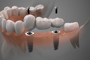 Digital illustration of an implant bridge