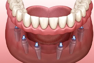 Digital illustration of implant dentures