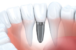 dental implant