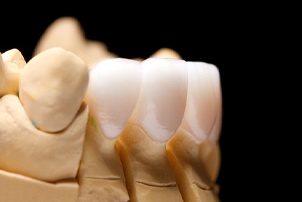 model of porcelain veneers