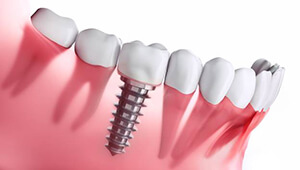 Dental implant