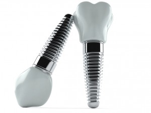  Life-like, long-lasting dental implants from your dentist in Centerville are the best way to replace teeth. 