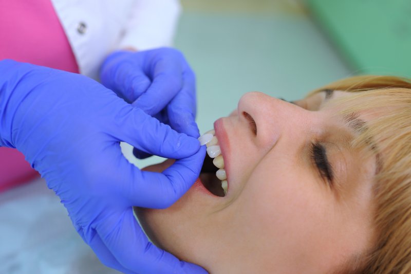 A dentist performing the veneer process