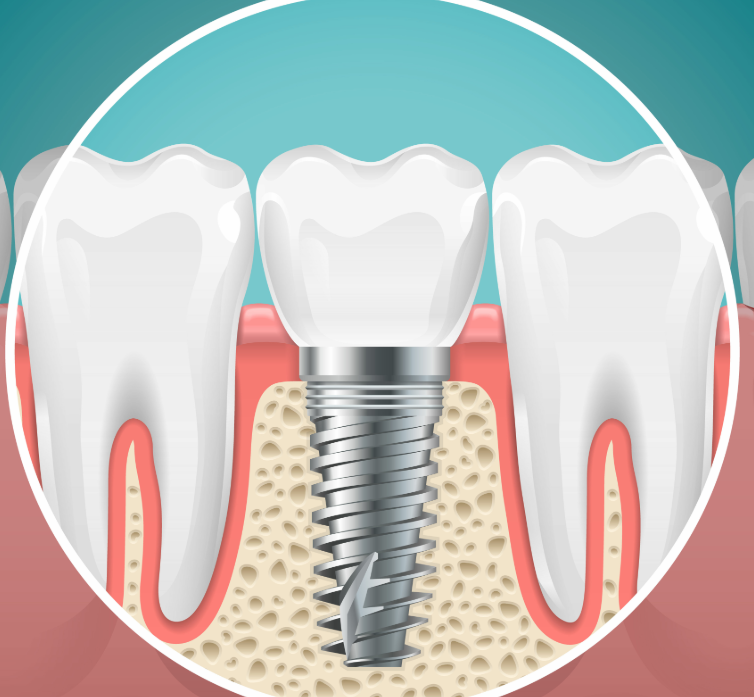 Illustrated cross section of a dental implant